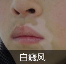白癜风