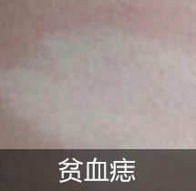 贫血痣