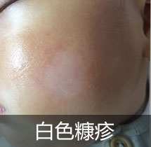 白色糠疹