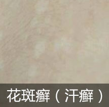 花斑癣