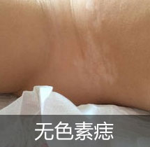 无色素痣