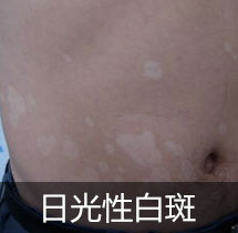 日光性白斑